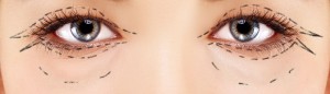 blefaroplastia-bh