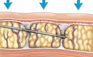 subincisao-bh